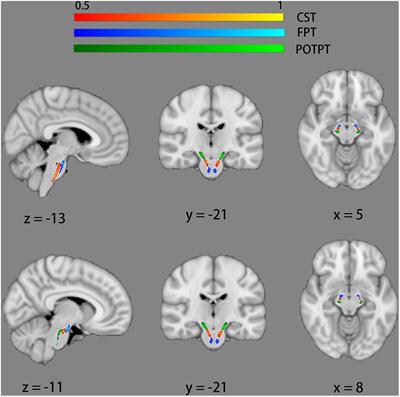 Brainstem Involvement in Amyotrophic Lateral Sclerosis: A Combined Structural and Diffusion Tensor MRI Analysis